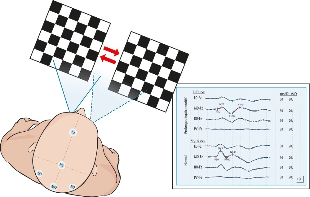 Image depicts an example of an evoked potential test and the results that come from measuring a participants electrical signals in response to certain stimulation.