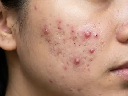 acne, blackheads and acne scars faq