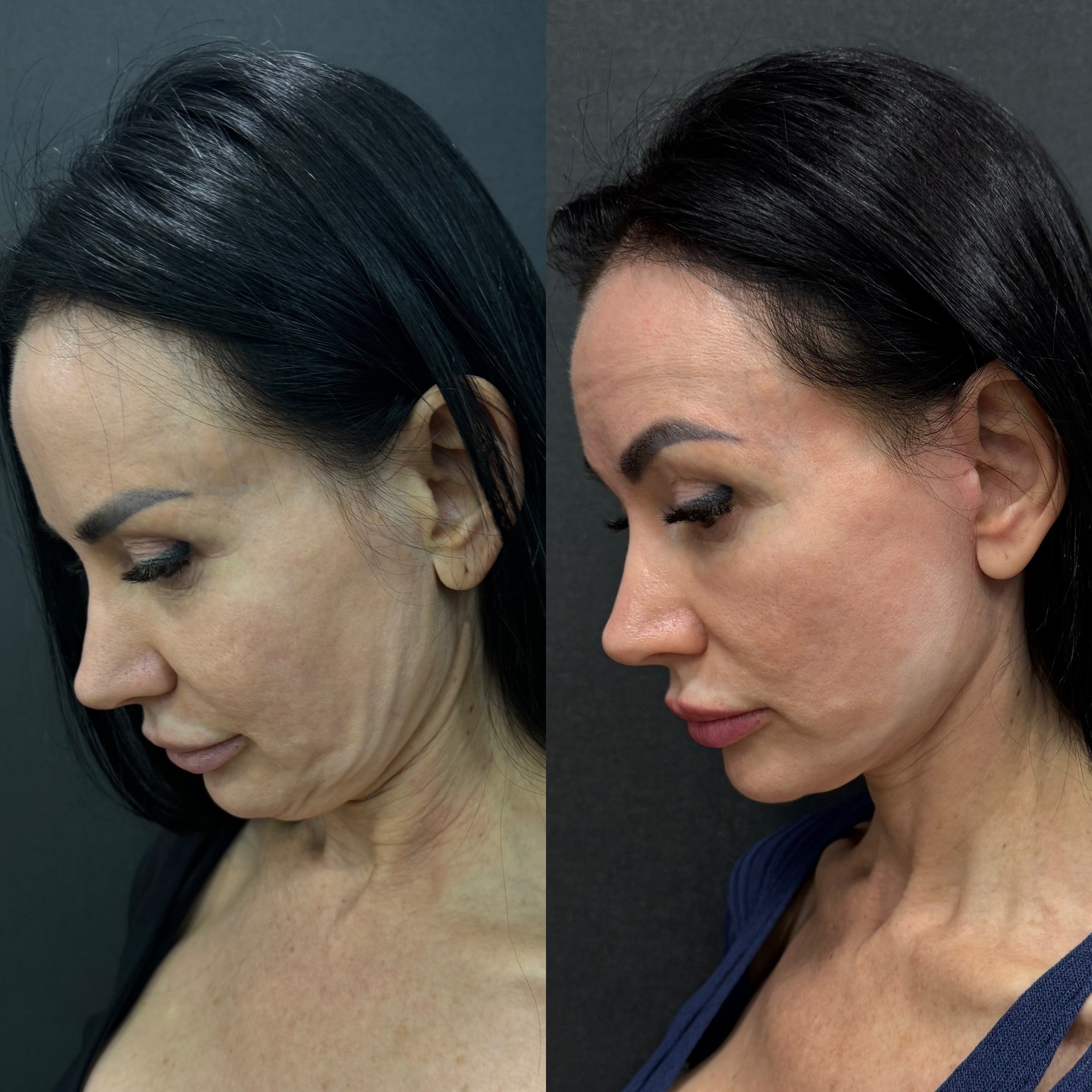 lower face & neck lift before after oblique view