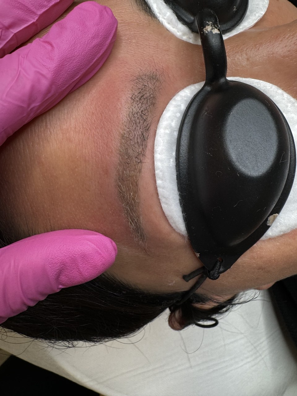 After Cosmetic Tattoo Removal Boston