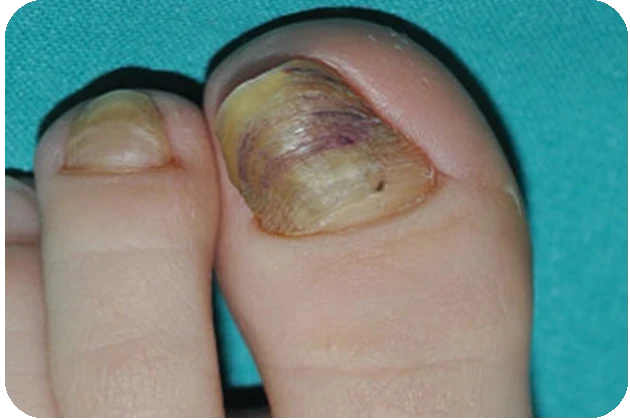 Severe thick / brittle