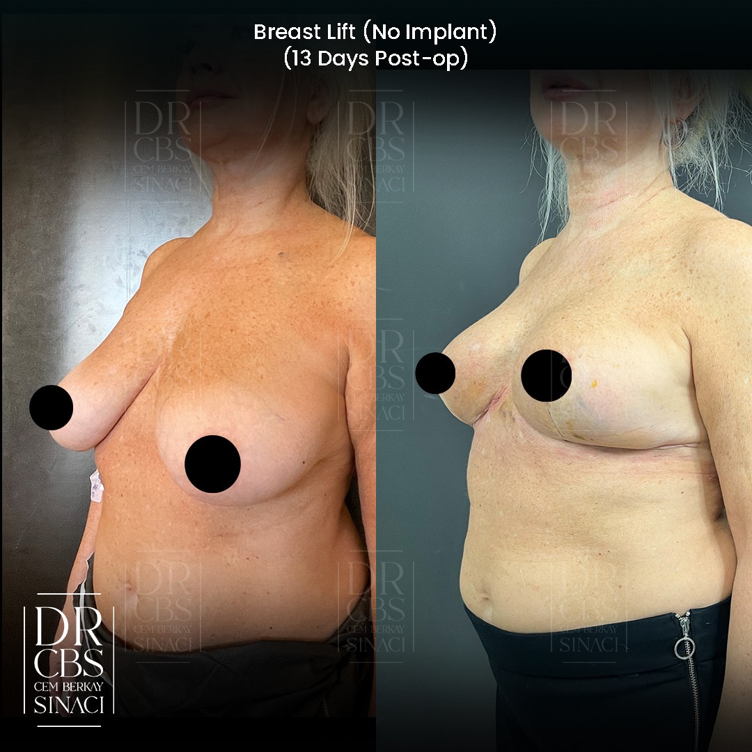 breast lift before after 13 days post-op no implant only auto augmentation oblique view