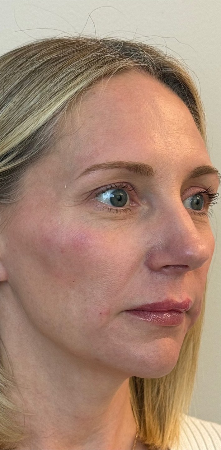 After: a woman with blonde hair in three-quarter view.