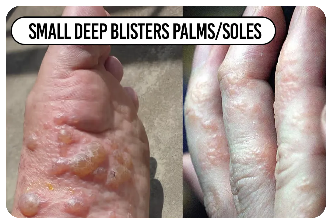 Small deep blisters palms/soles