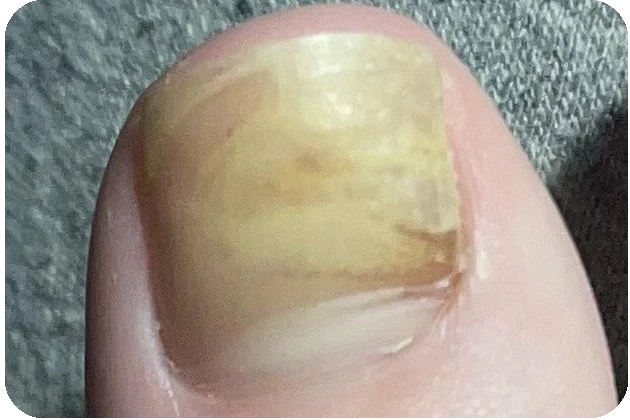 Nail lifting (gap)