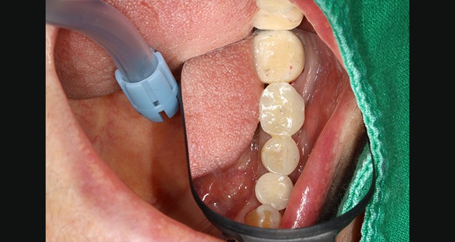 보철셋팅