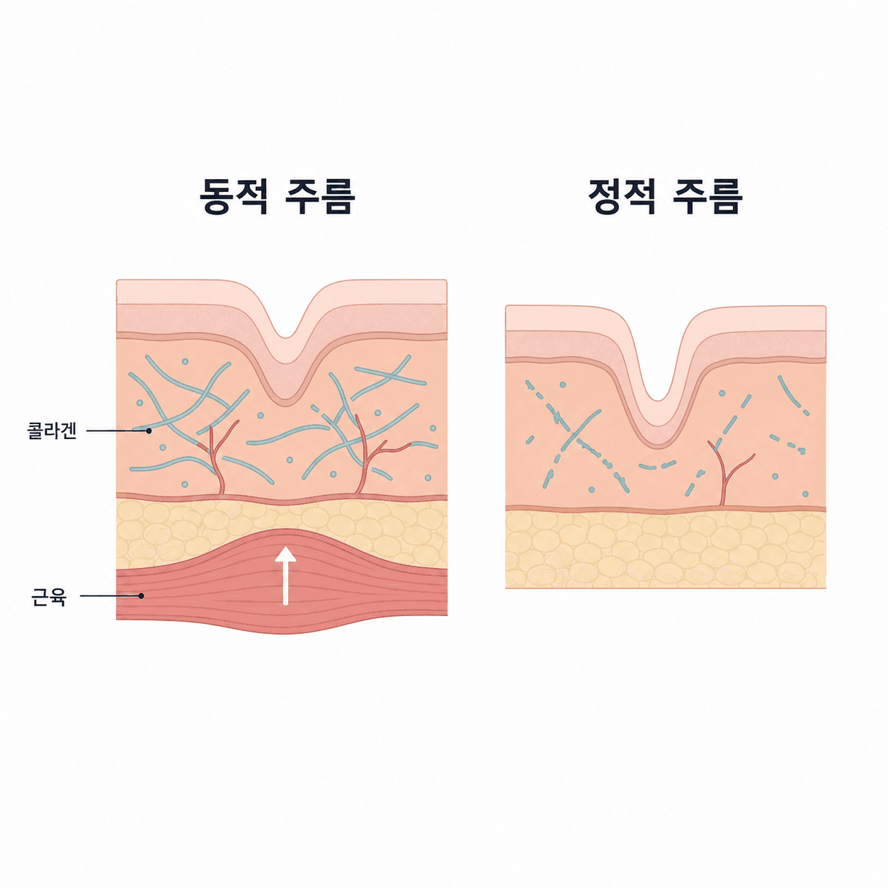 근육 수축으로 접히는 동적 주름과 피부 구조가 바뀌어 고정된 정적 주름의 비교