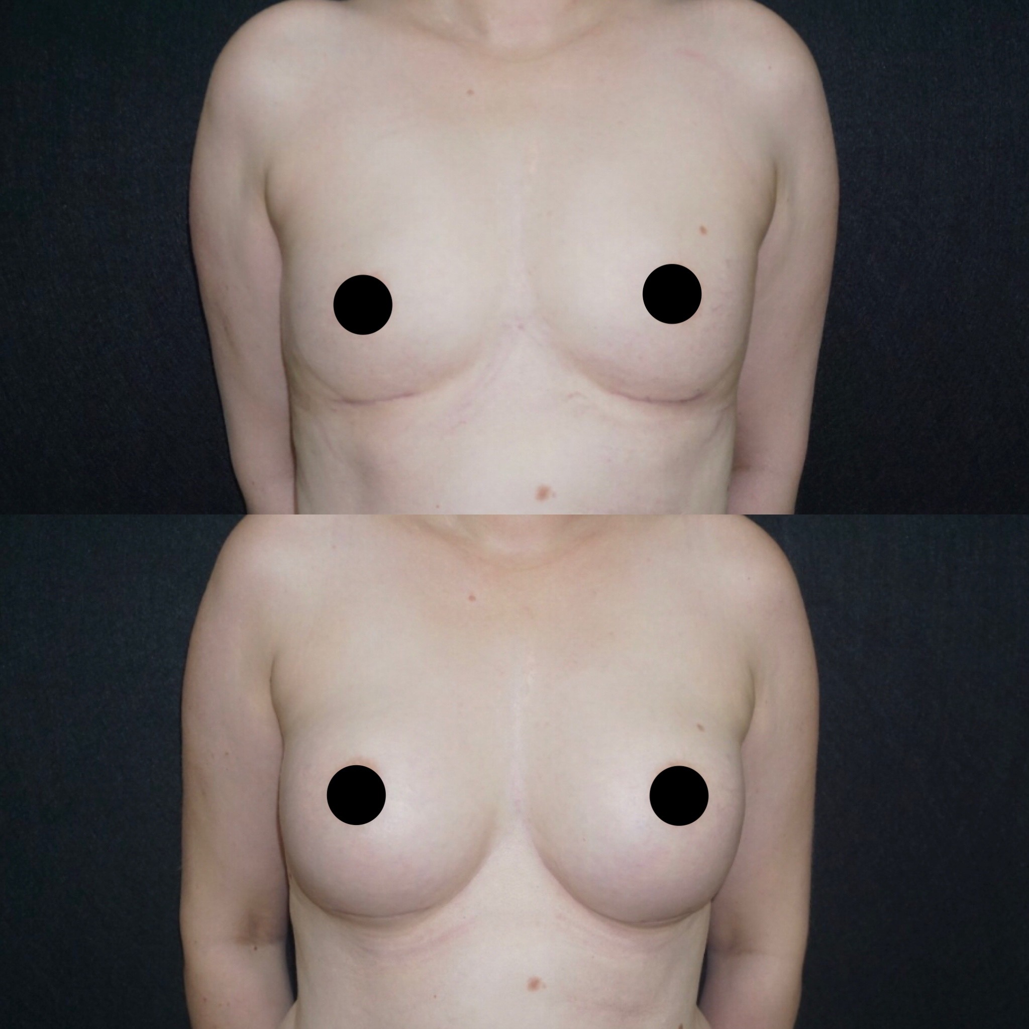 2 months post op revision breast implant before after