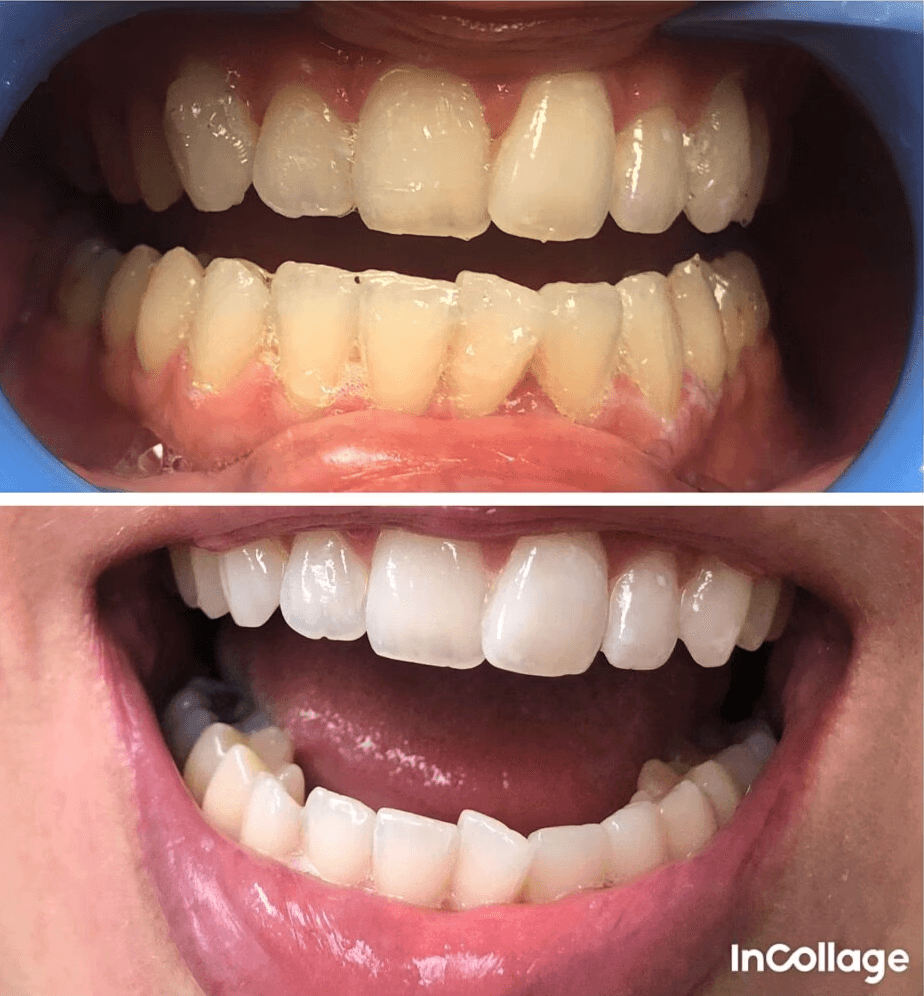 Teeth whitening treatment before and after