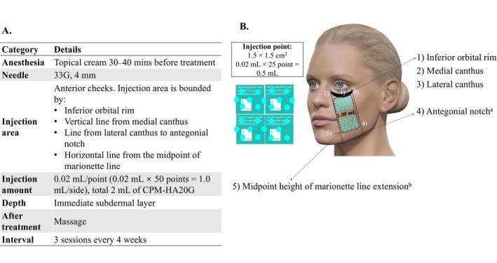 Facial injection protocol and treatment area diagram