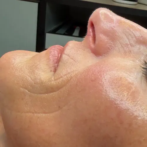 After dermaplaning at The Vancouver Aesthetician — skin instantly glowing, smoother, and visibly healthier and more youthful