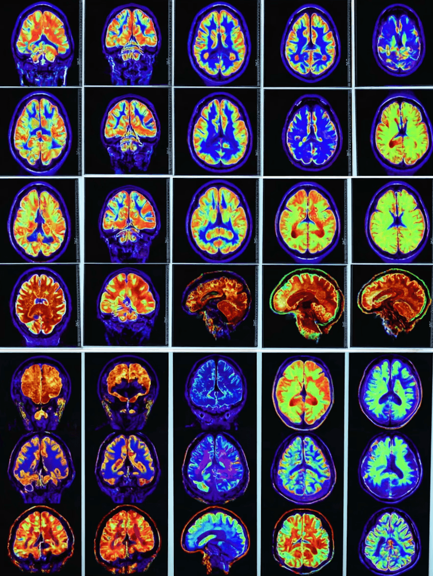 QEEG Brain Map EEG Brain Scan