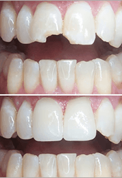 Before and after dental restorations