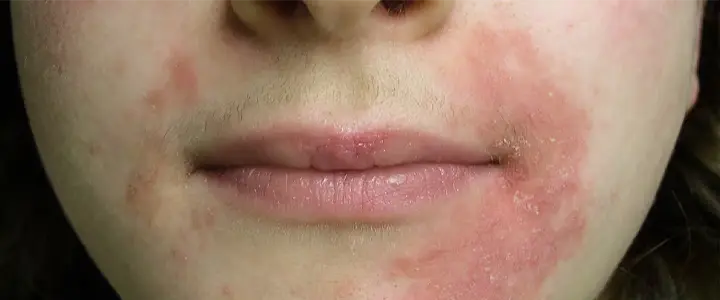 Red bumps or patches around mouth, nose, or chin (lips usually clear)