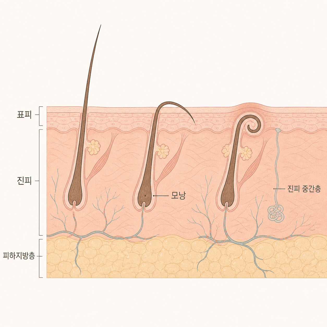 모낭 각도와 털의 굽는 방향에 따라 갈리는 세 가지 경우