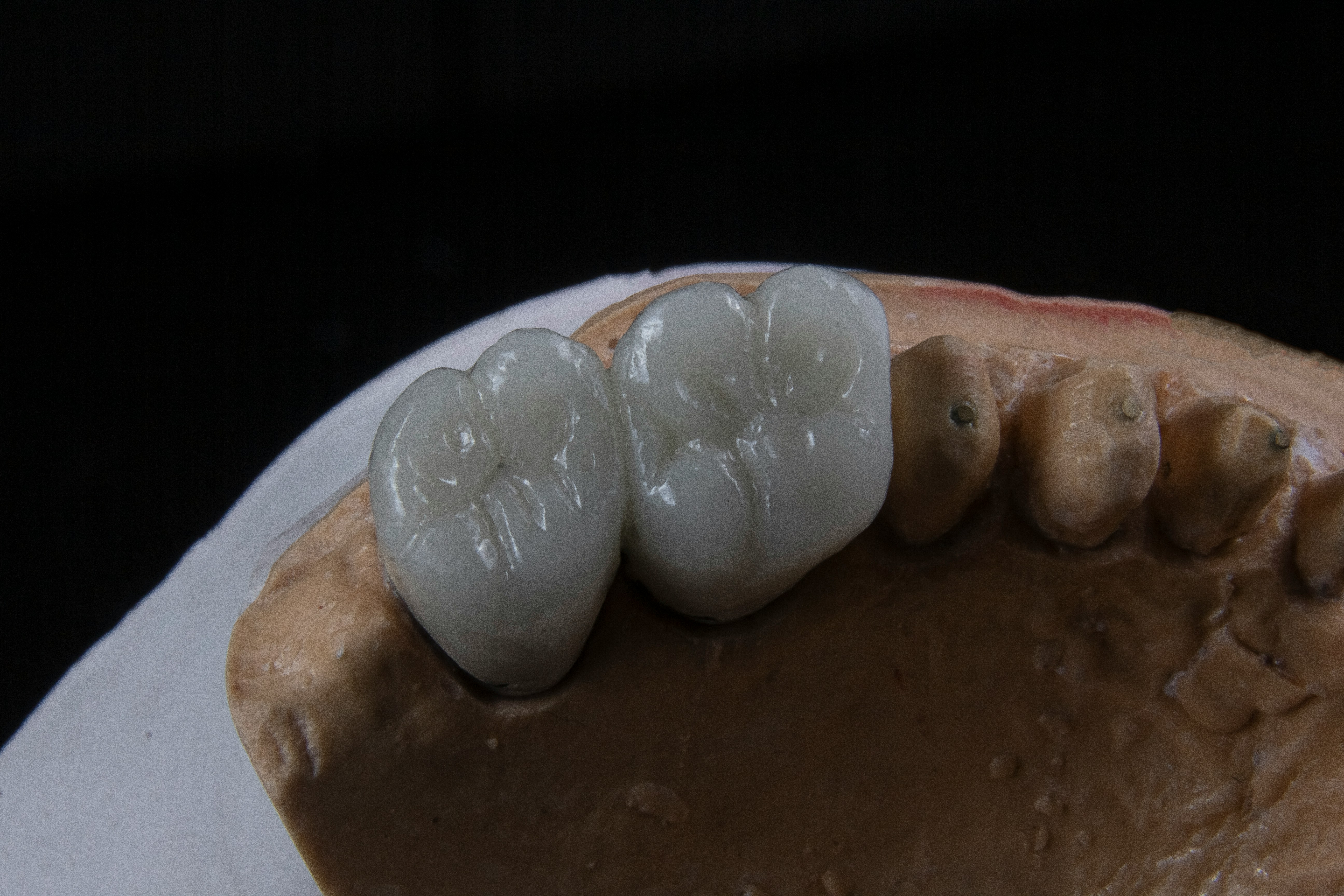 Dental Implants Garfield