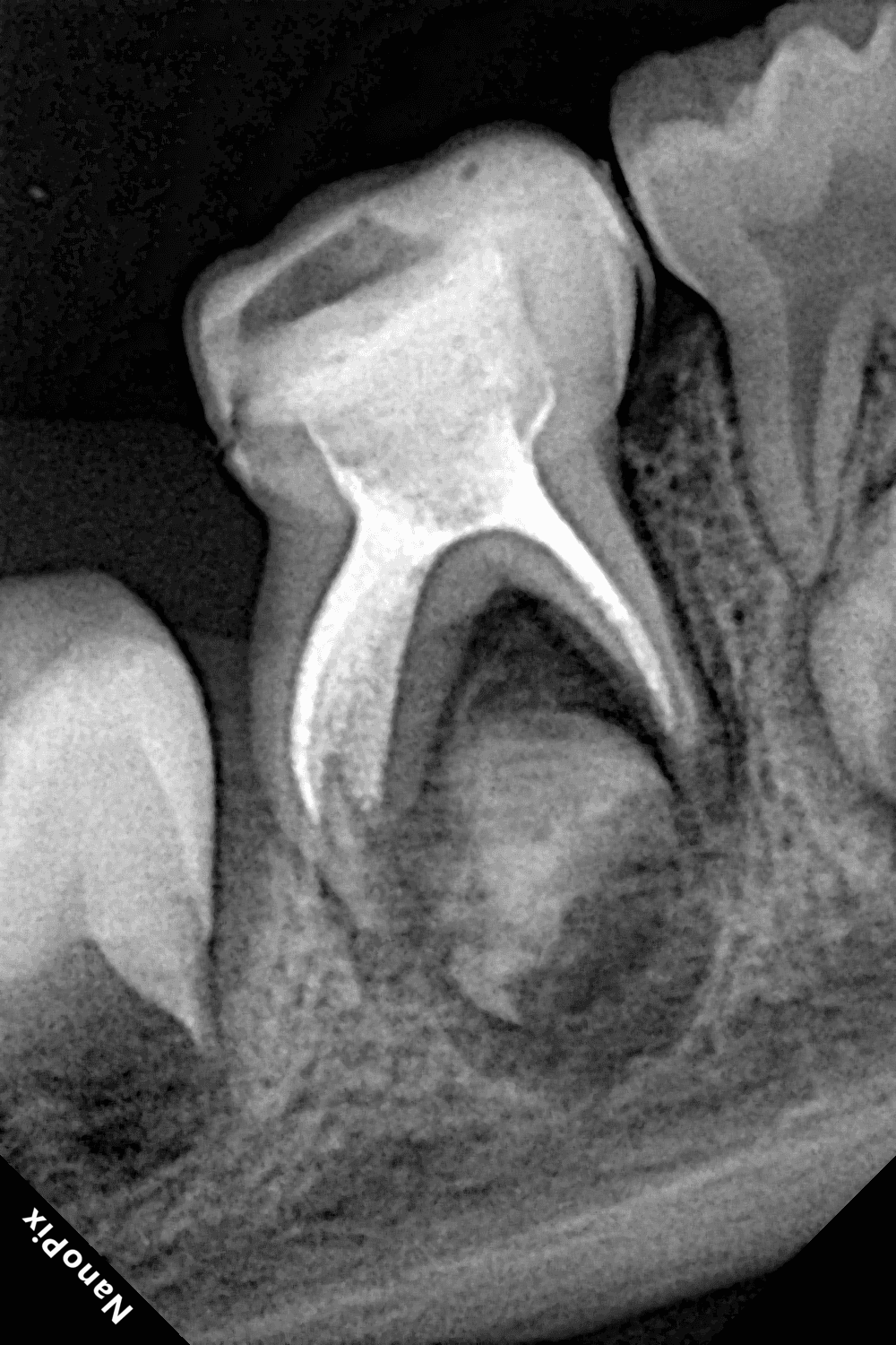 Root canal treatment in a child’s milk tooth