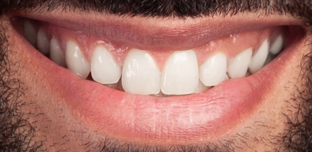 Fogászati esztétika előtte–utána – mosoly átalakítás