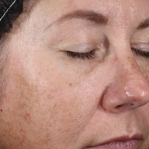 Before antioxidant treatment at The Vancouver Aesthetician — visible cheek pigmentation, early fine lines around the eyes and nasolabial folds around the mouth