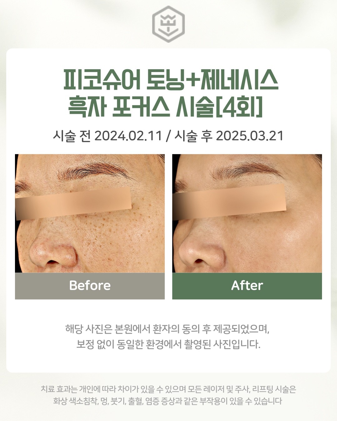 피코슈어+제네시스+흑자포커스 4회