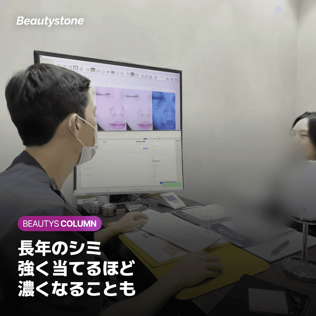 長年のシミに強いレーザーは逆効果になることも。弱いエネルギーで繰り返すトーニングが基本です