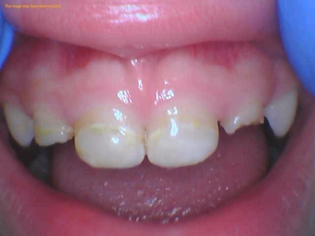Close-up clinical image of a child’s upper front teeth before zirconia crowns, with visible wear and discoloration on the teeth and gloved hands lifting the lip.