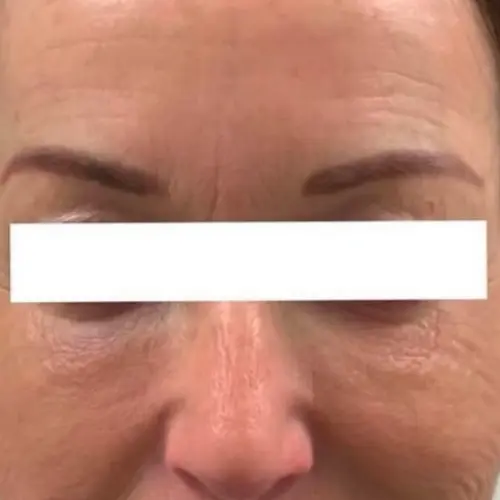 Before microneedling anti-aging treatment at The Vancouver Aesthetician — visible fine lines around the eyes and forehead with tired dull skin