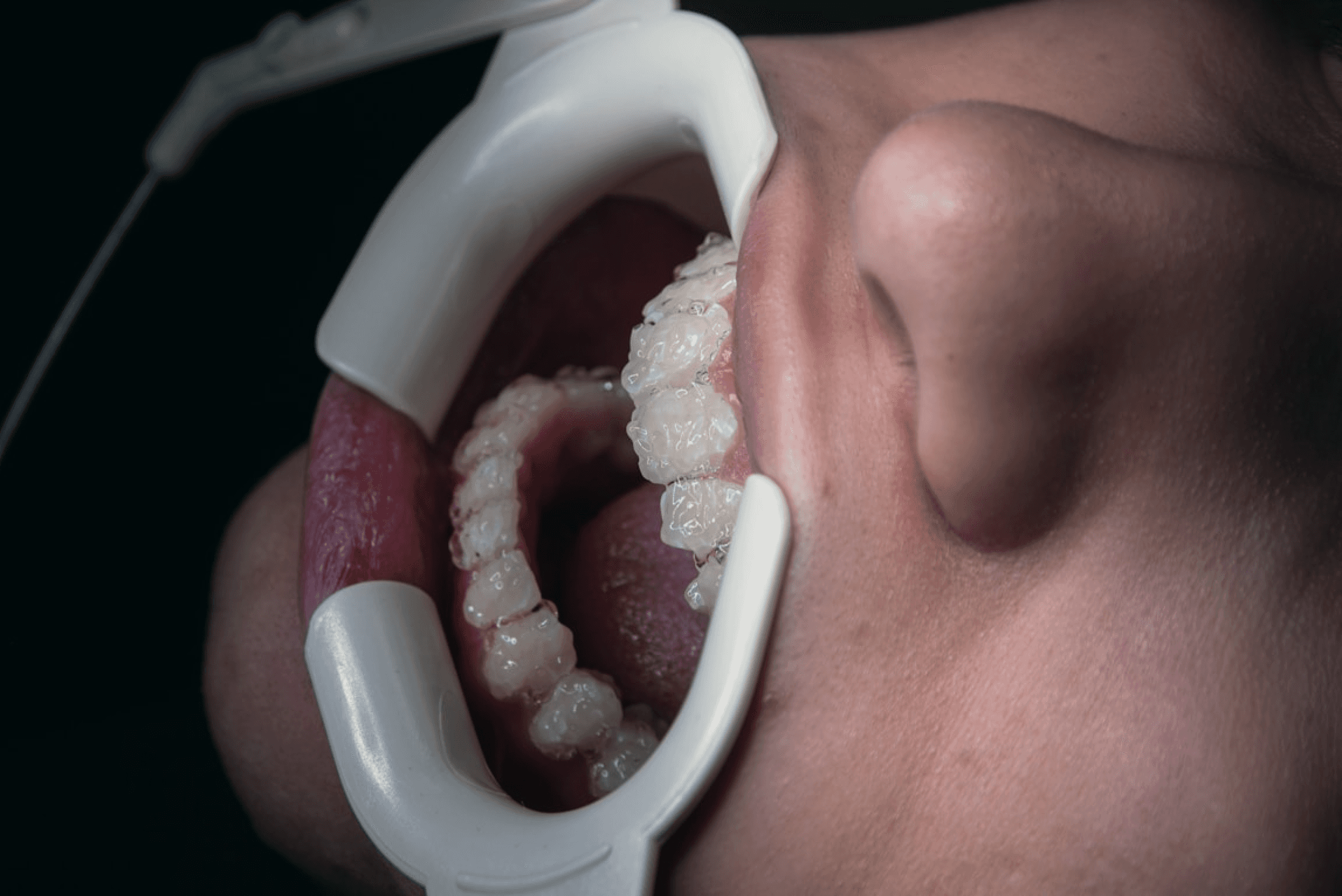 A close-up image shows a dental procedure in progress, with a person's mouth held open by a white dental retractor, revealing braces on the teeth, highlighting aspects of orthodontic treatment and oral healthcare.