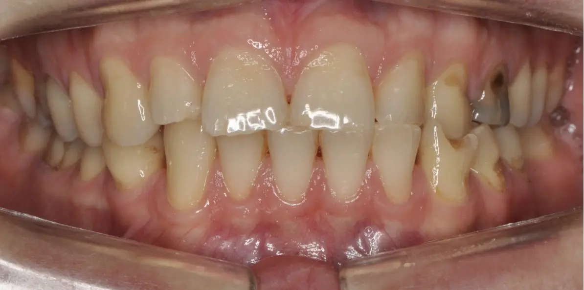Prima e dopo il trattamento ortodontico funzionale, senza estrazione dei denti premolari