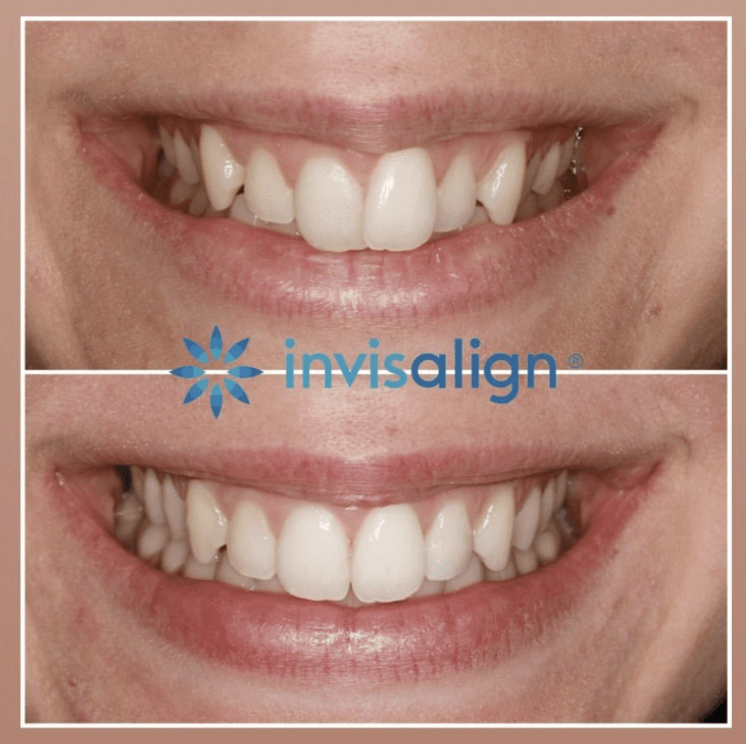 A female’s teeth with an invisalign before and after photo corrected from a misaligned to a straight smile at Invisalign Center.