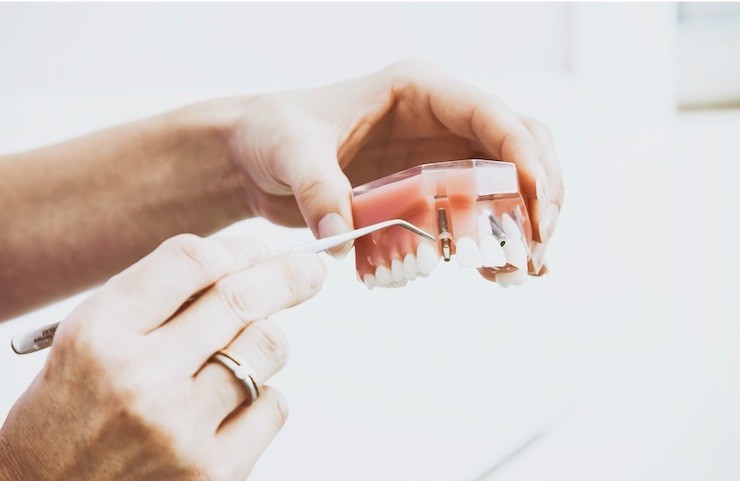 Teeth Implants