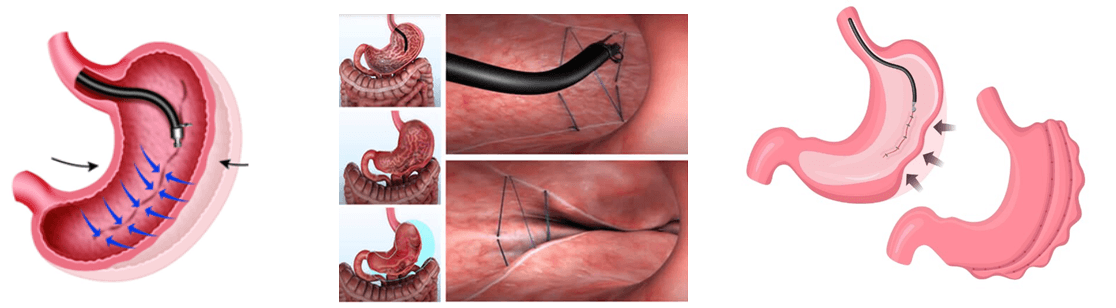 Indications of bariatric surgery | Dr Aloy Mukherjee