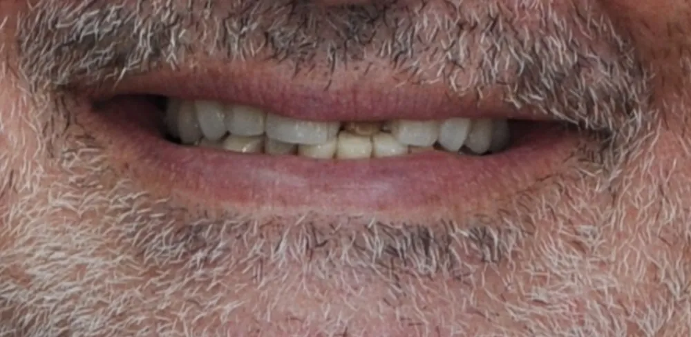 Before ortho treatment