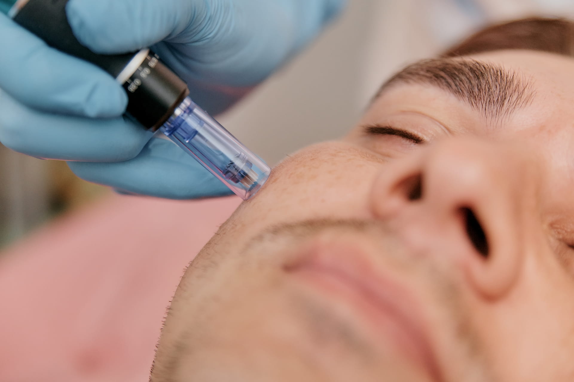 Medical-depth microneedling on man at Avinity Health in Scottsdale.
