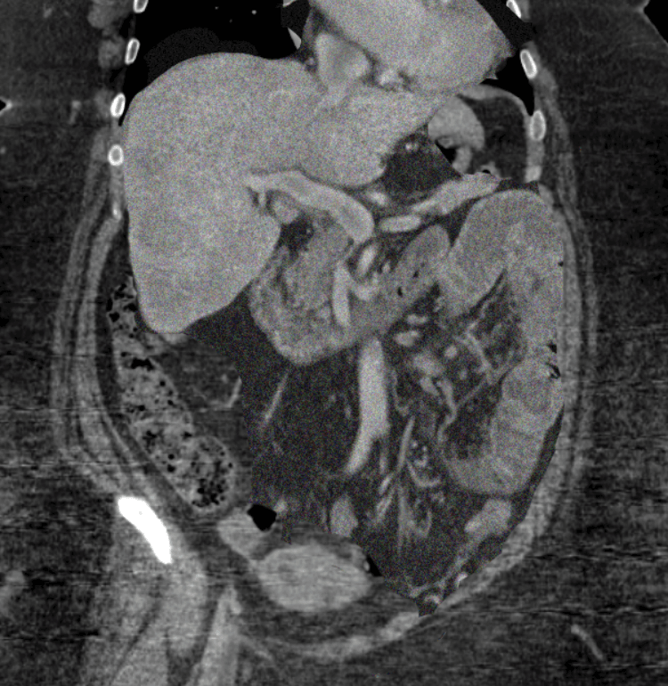 Conventional iodine contrast image state