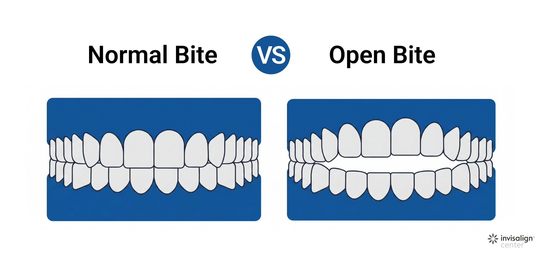 Comparison of normal bite alignment and open bite with visible front teeth separation 