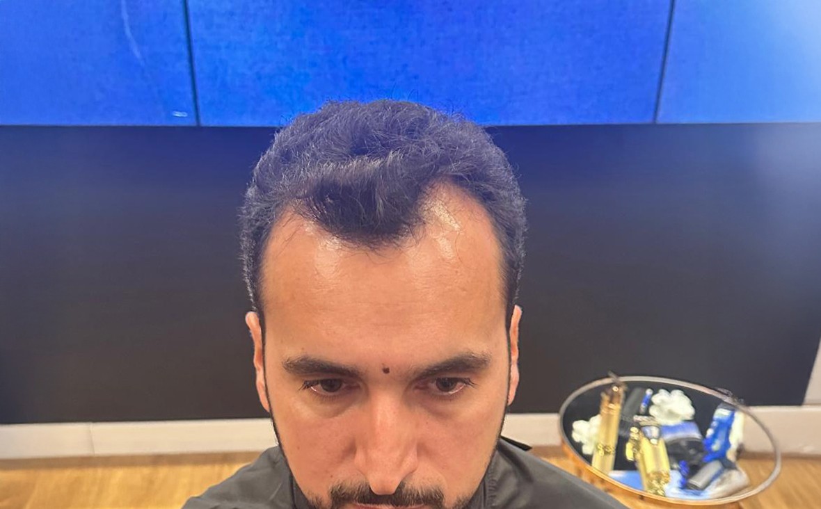 Homem calvo mostrando como era antes do transplante.