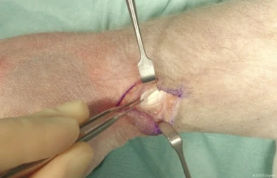 De Quervain’s release