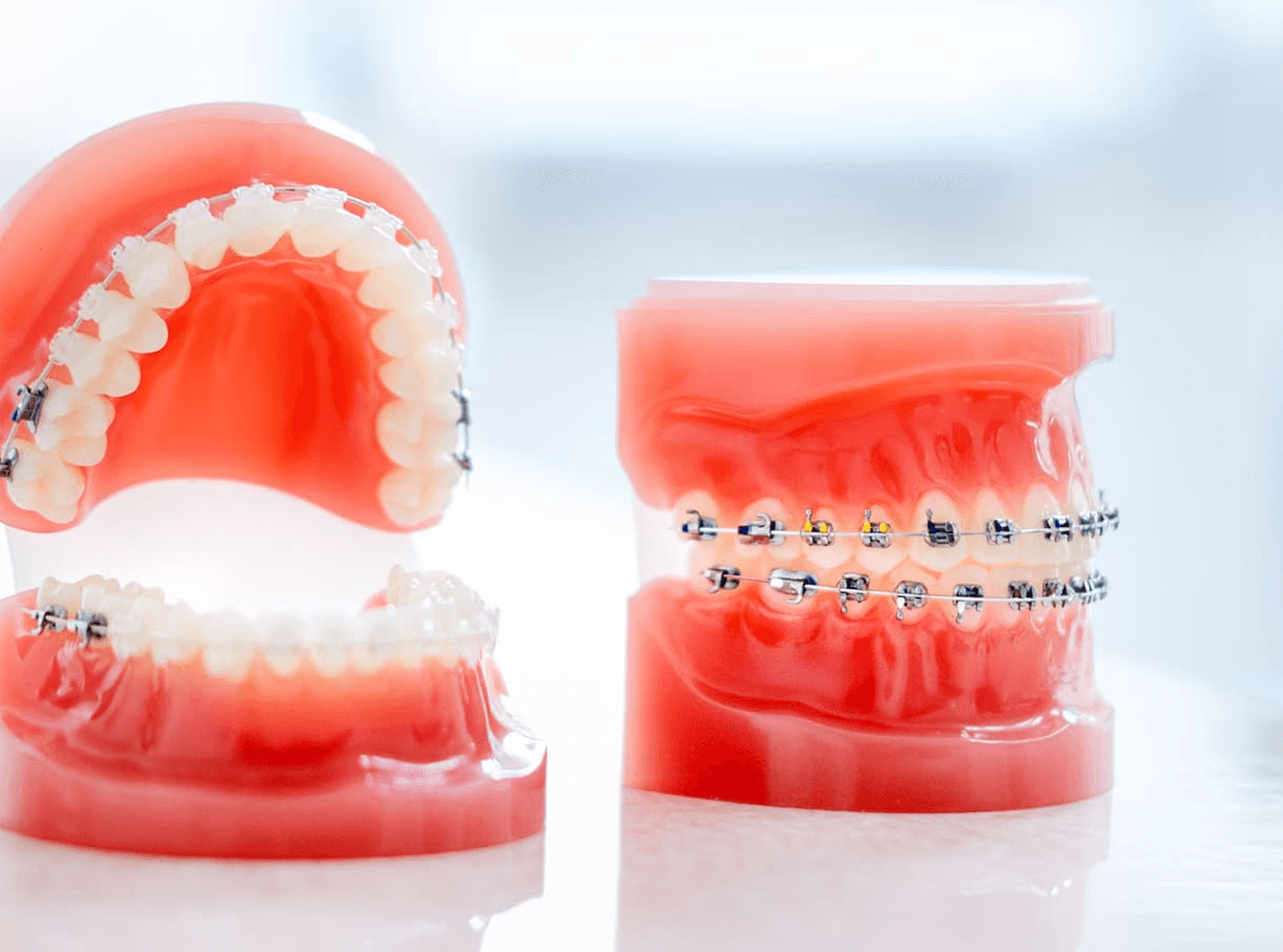 マウスピース矯正