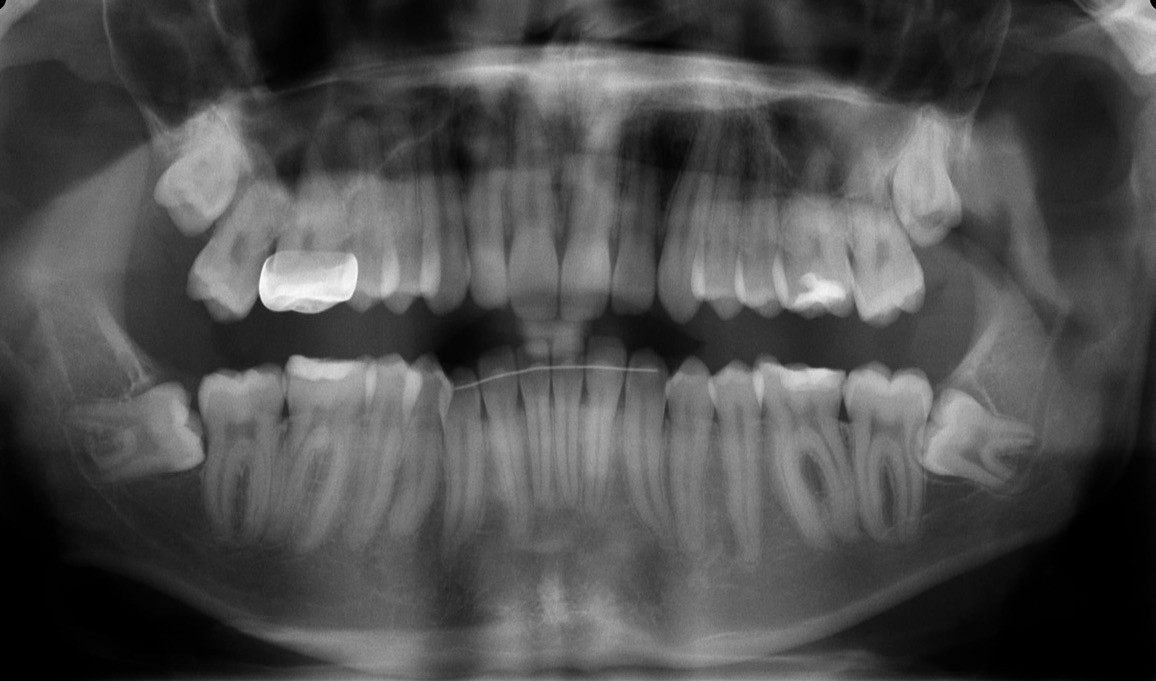 A panoramic dental X-ray image showing a full set of adult teeth, with clear views of the upper and lower jawbone structure, highlighting the alignment and positioning, and featuring a dental filling visible on one of the upper molars at Oakville Dental Implant Studio.