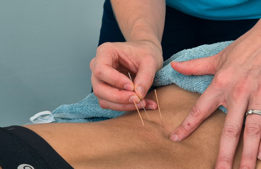 Dry needling