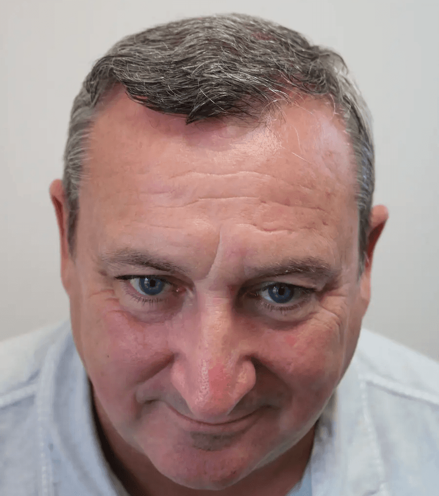 After hair transplant – Peter's FUE Hair Transplant