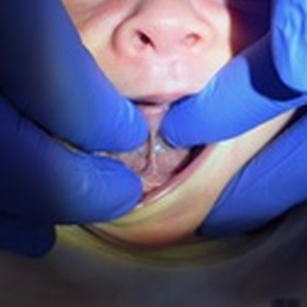     Close-up clinical image of a baby’s tongue tie before frenectomy, with gloved hands gently lifting the tongue to show the restricted frenulum.
