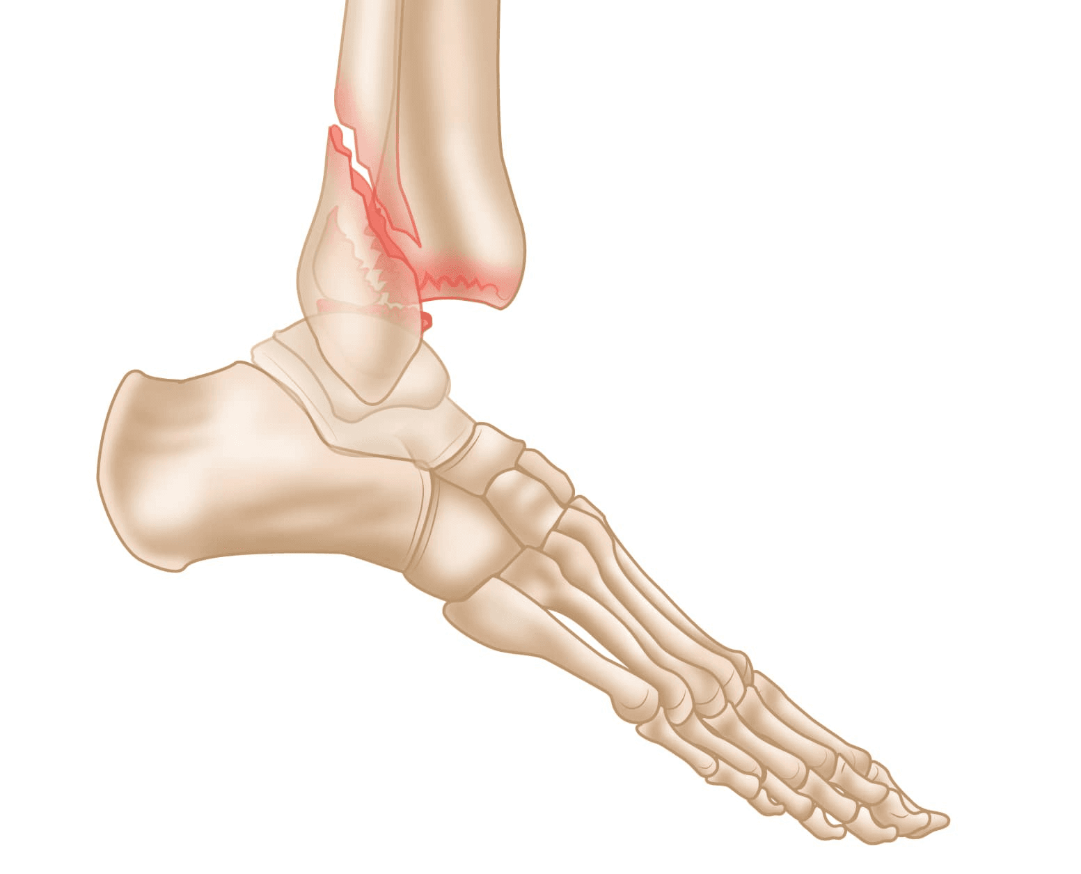 Ankle Fracture illustration