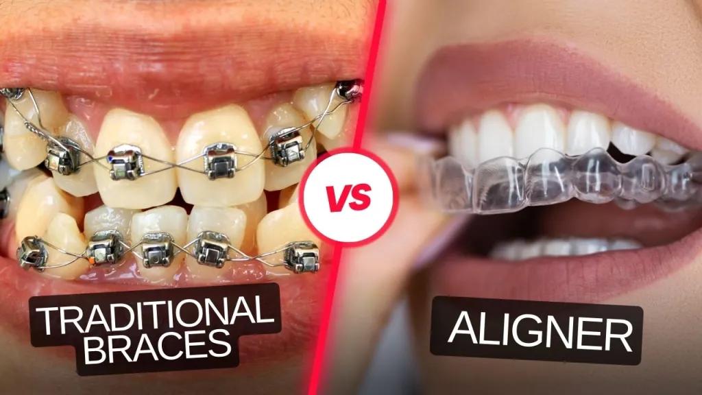 Dental Braces