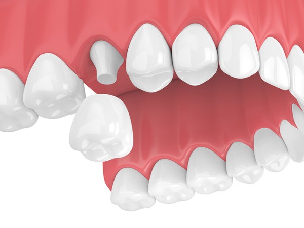 Same-Day Dental Crown Rochelle Park