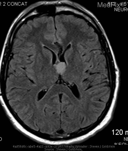 MRI image of a brain