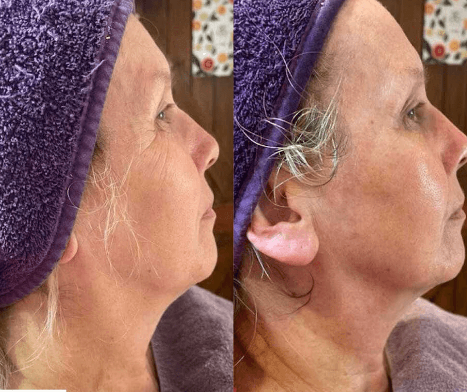 Laser treatment on woman's cheek with protective eye shield