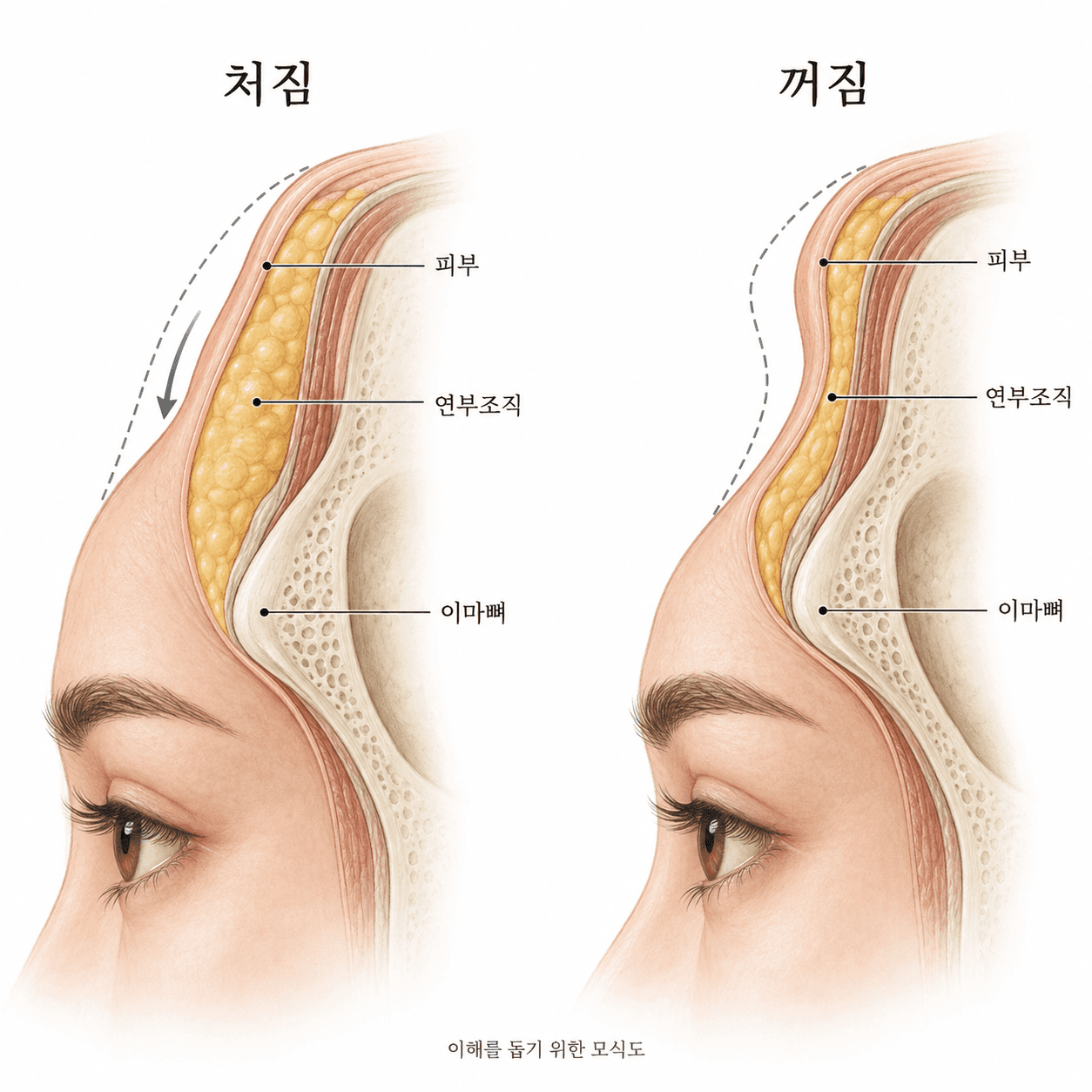 이마 연부조직의 처짐과 볼륨 감소로 생기는 꺼짐을 비교한 모식도