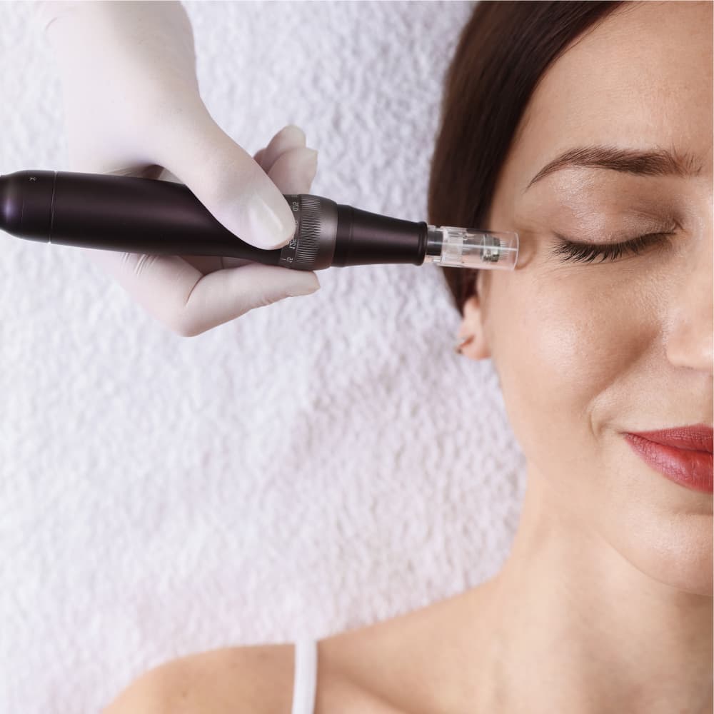 Microneedling results at Avinity Health